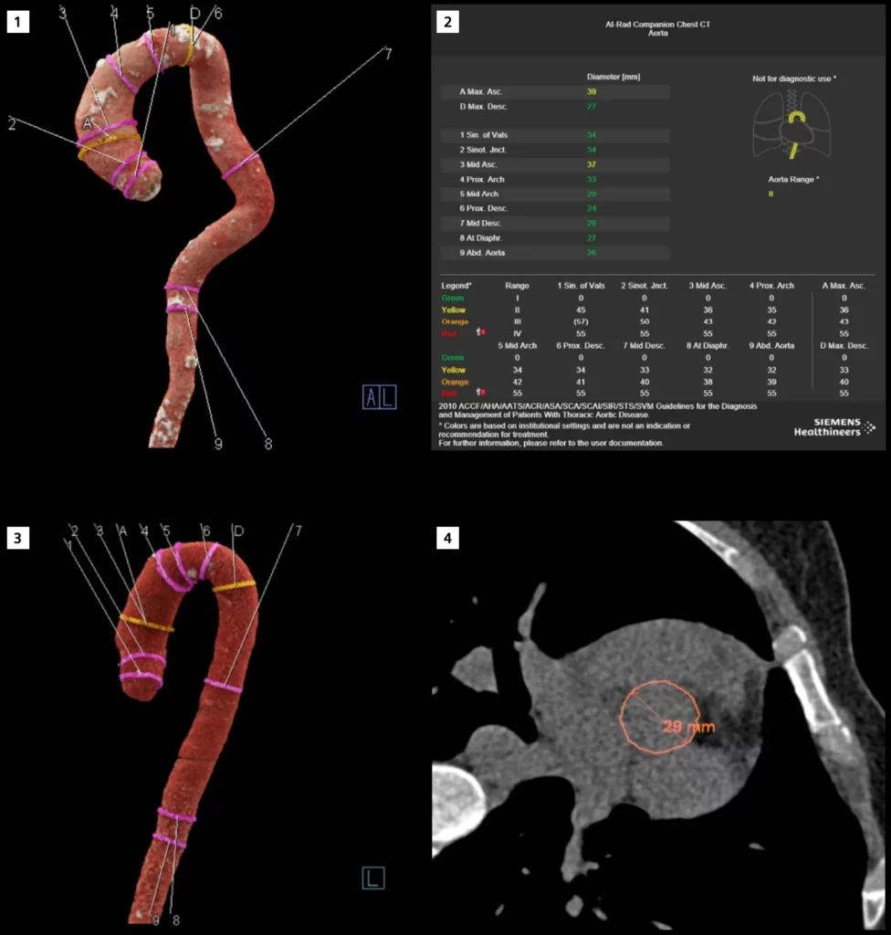 How AI-Rad Companion Chest CT helps Diagnostikum in aorta examination