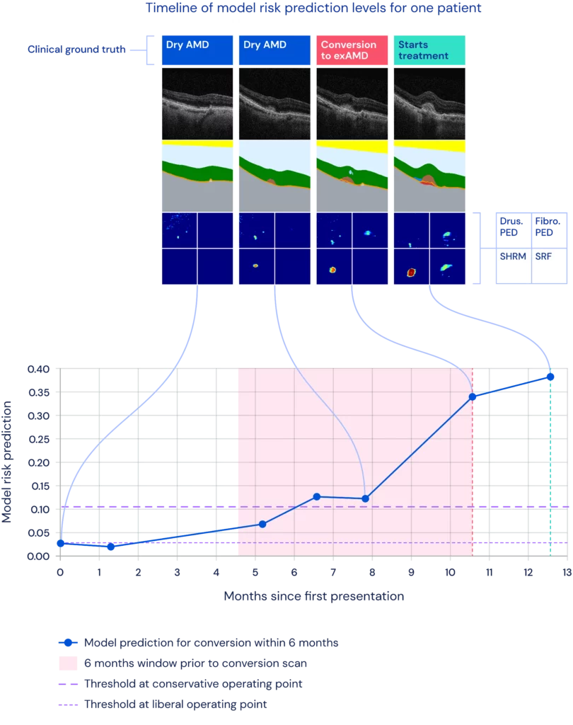 an example of how AI can predict the high risk of an eye converting to exudative AMD